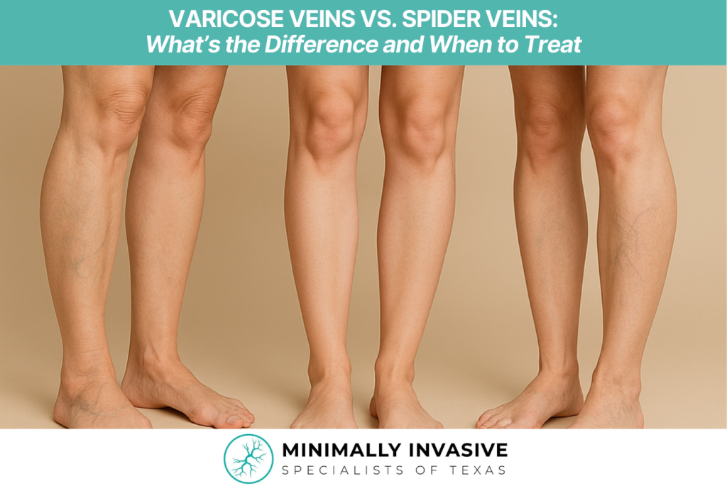 Varicose Veins vs. Spider Veins What’s the Difference and When to Treat