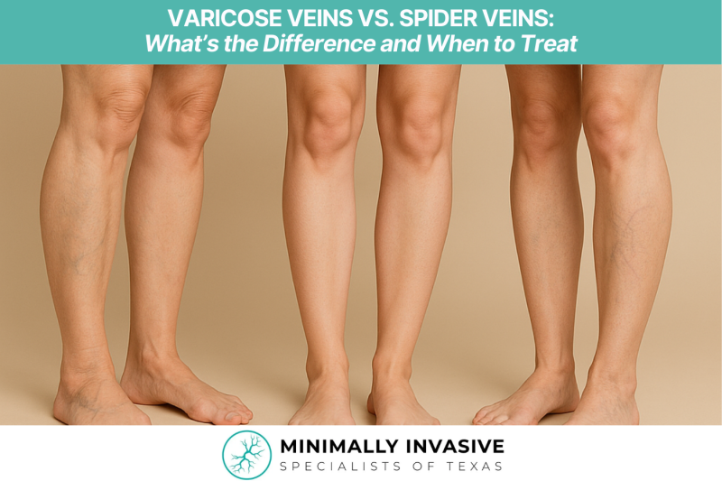 Varicose Veins vs. Spider Veins What’s the Difference and When to Treat