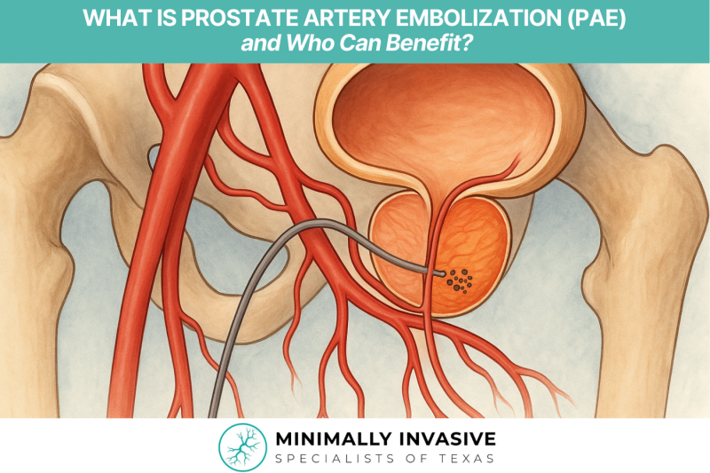 What Is Prostate Artery Embolization (PAE) and Who Can Benefit